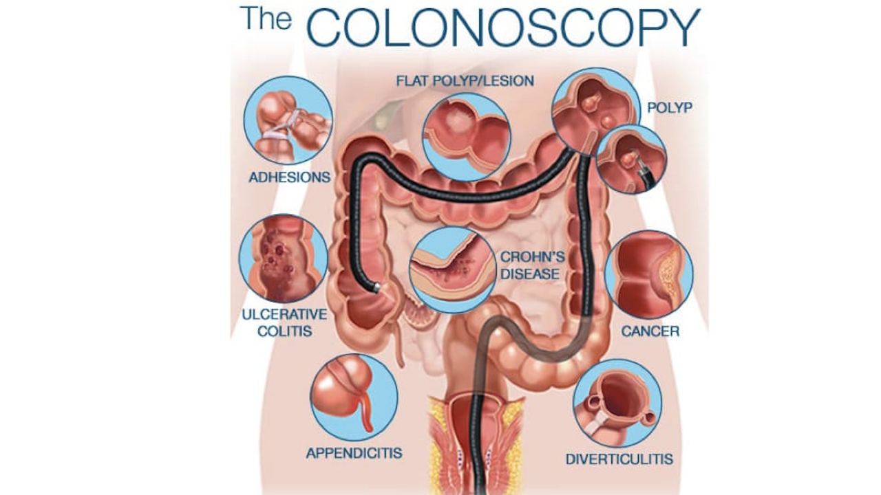 The Colonoscopy