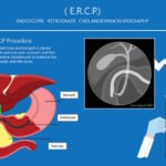 ERCP Procedure