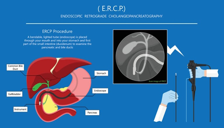 ERCP Procedure