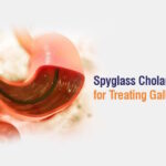 Spyglass Cholongioscopy