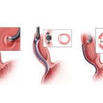 Third Space Endoscopy