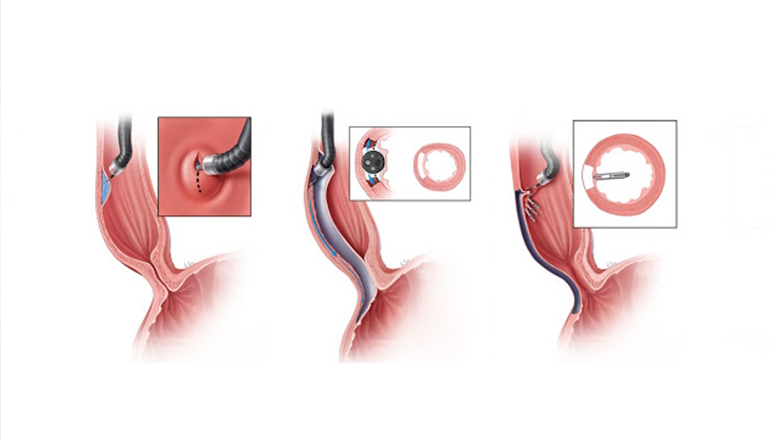 Third Space Endoscopy